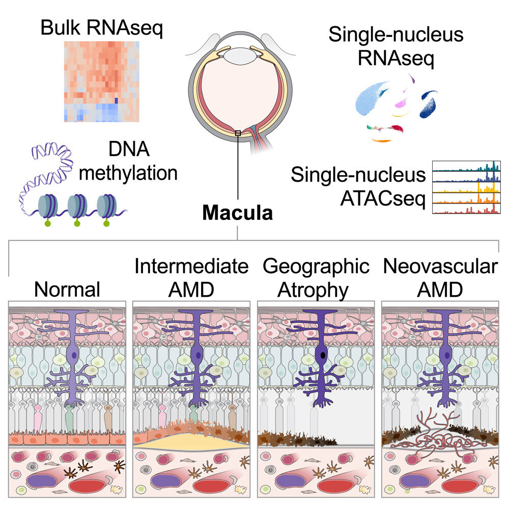 Featured image for Causal genes for age-related macular degeneration identified in new study.