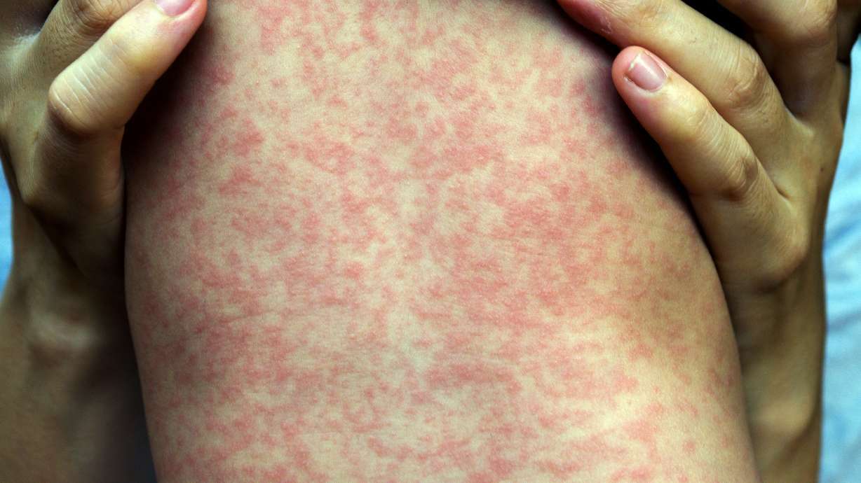 Utah's Measles Cases Rise to Five, Including Pregnant Women