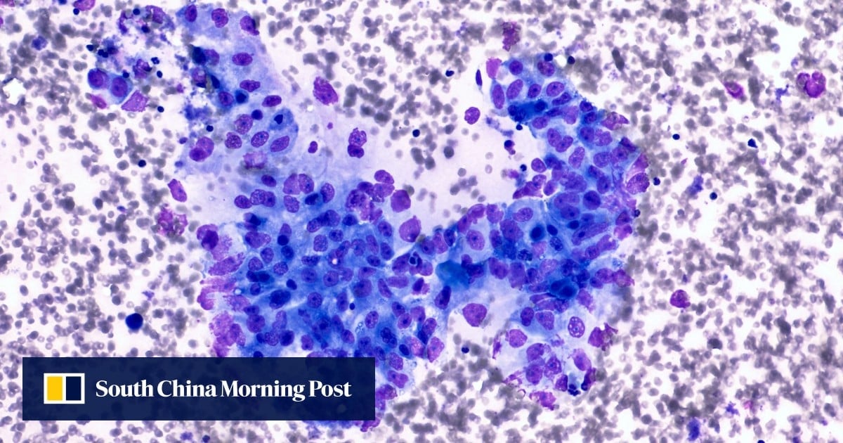 Featured image for "Breakthrough in Pancreatic Cancer Treatment: Chinese Scientists Uncover Promising Protein Markers"