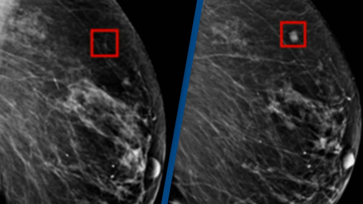 AI predicts breast cancer 4 years in advance.