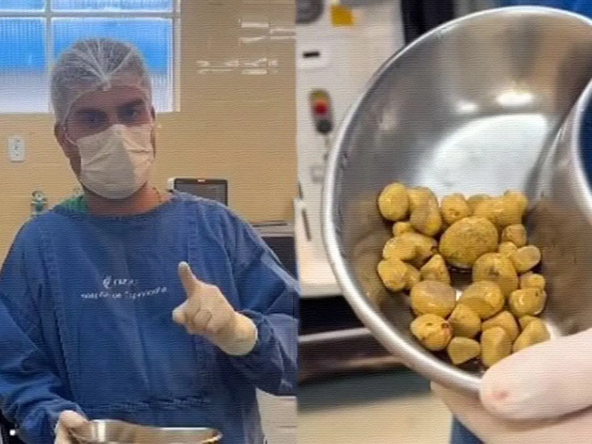 Featured image for Coca Cola Causes Shocking Kidney Stones: 35 Removed