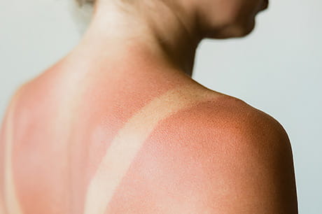 Featured image for "Sunburn SOS: Kitchen Remedies and Natural Tips for Fast Relief"
