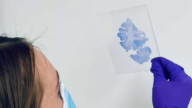 Featured image for SuperAgers' brains reveal secrets to cognitive resilience and aging