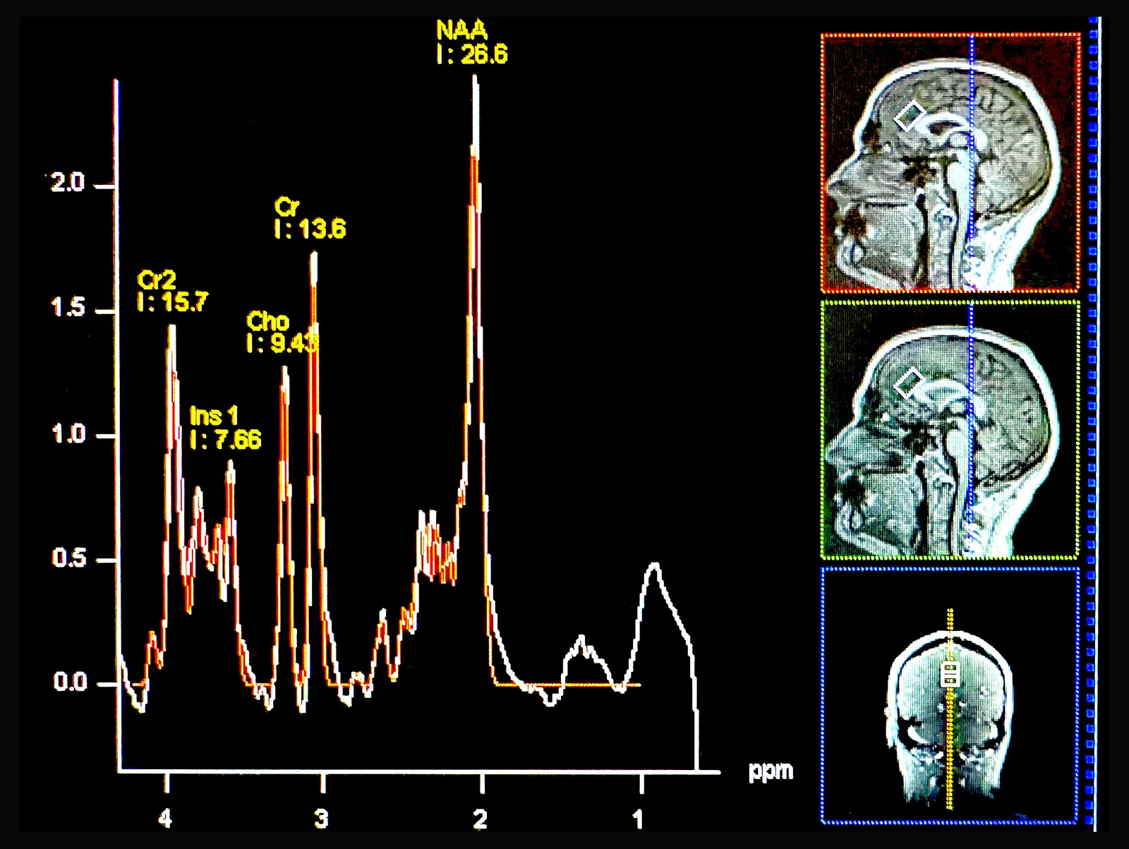 Featured image for Low Brain Nutrient Levels Linked to Anxiety Disorders