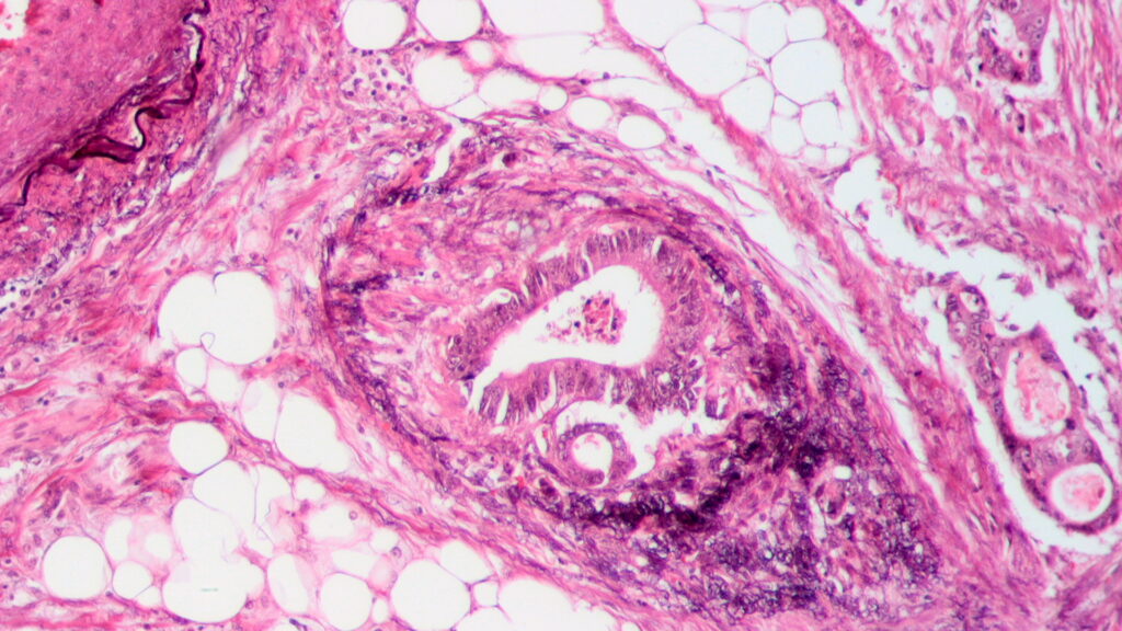 Featured image for Sugary drinks and lifestyle contribute to alarming rise in cancer among young adults