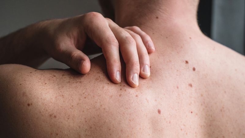Melanoma vaccine combo shows promise in delaying relapse.