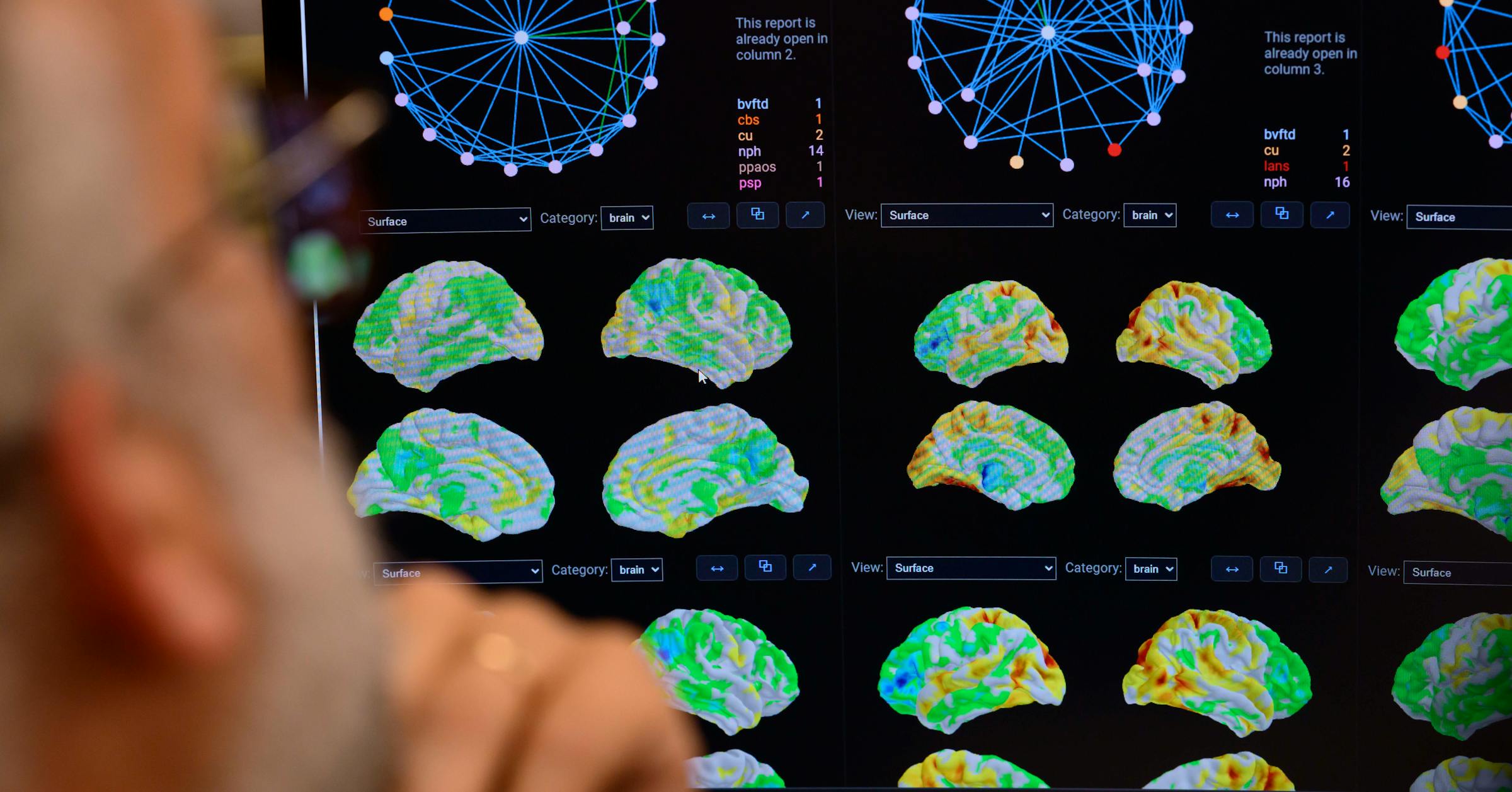 Featured image for Mayo Clinic's AI Drive and Machine Learning in Alzheimer’s Risk Prediction