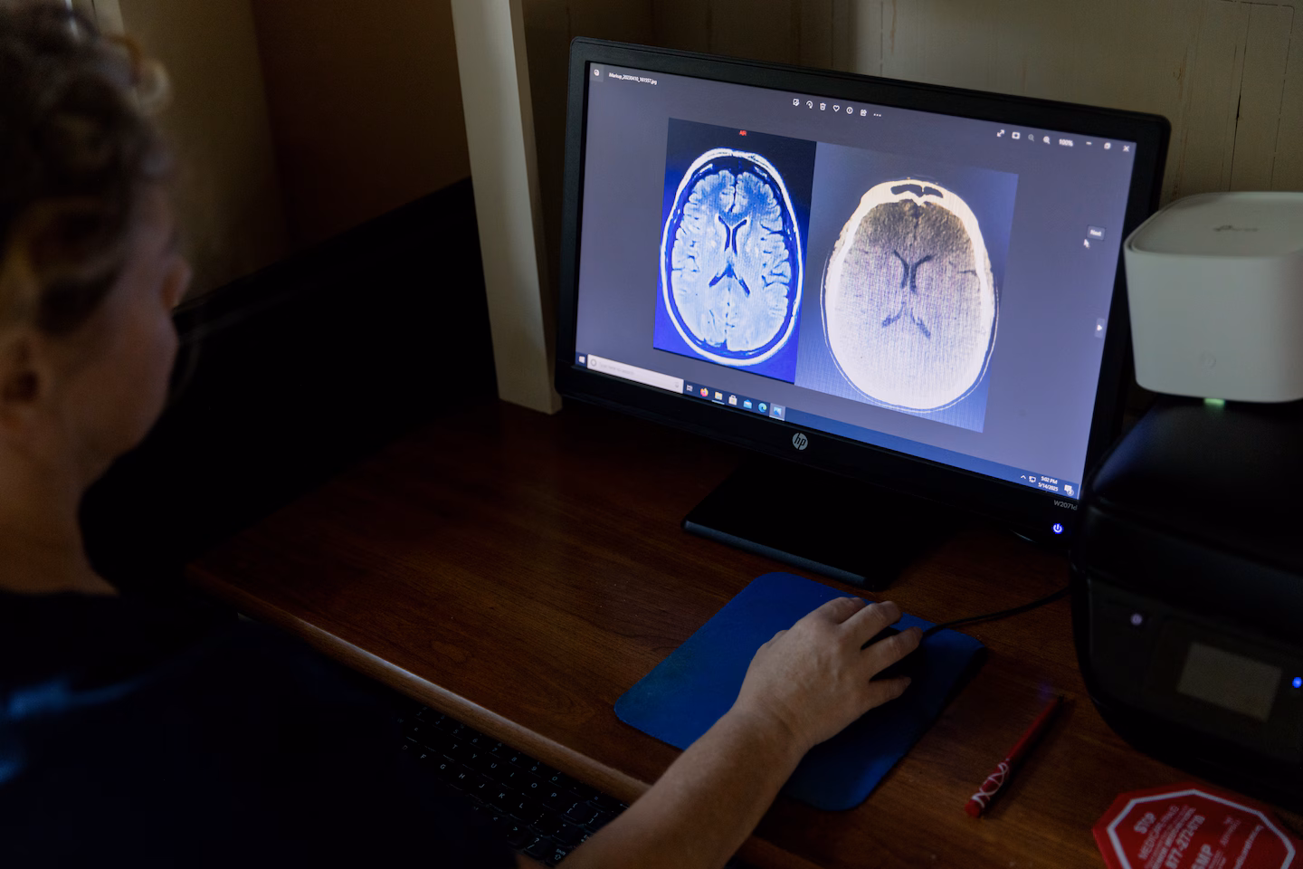 Featured image for Progress Nears in Developing Drug to Reduce Artery-Clogging Particle