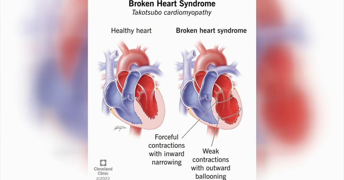 Featured image for "Schuylkill County Mother's Battle with Broken Heart Syndrome"