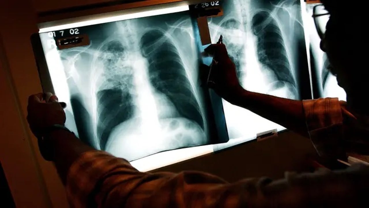 Featured image for Tuberculosis Patient Faces Jail for Casino Visit and Refusing Treatment
