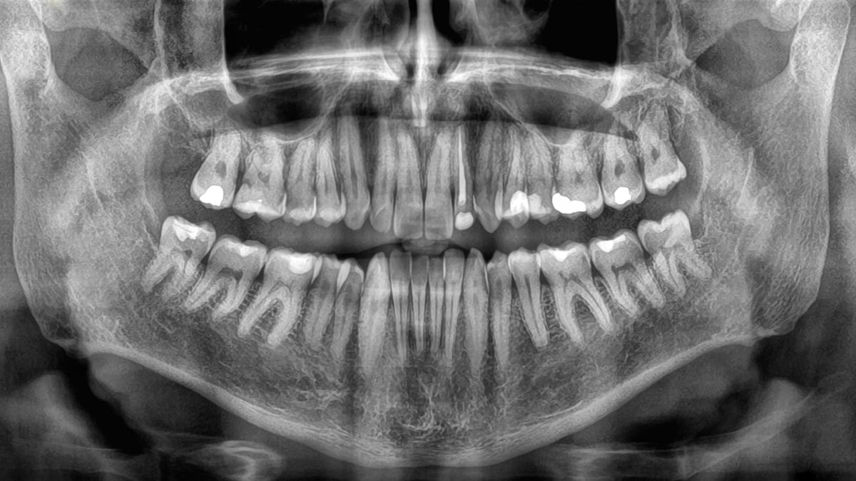 Featured image for Tooth Loss May Signal Serious Health Risks, Study Warns