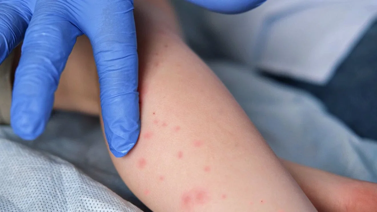 Measles confirmed in Pensacola area as vaccination push heats up