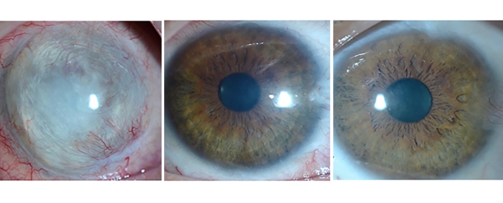 Featured image for Revolutionary Stem Cell Treatment Restores Vision in Eye Injuries