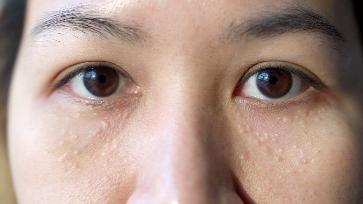 Understanding and Treating Milia at Home.