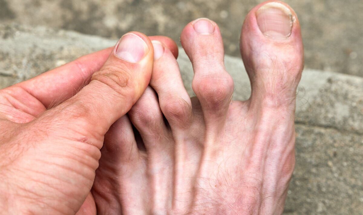 Featured image for 3 Surprising Signs of High Cholesterol to Look Out For