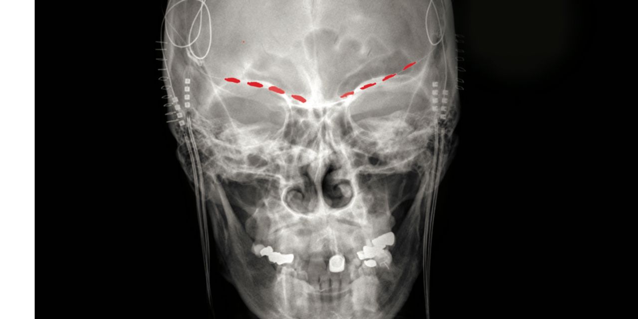 Uncovering Brain Signatures for Treating Chronic Pain.