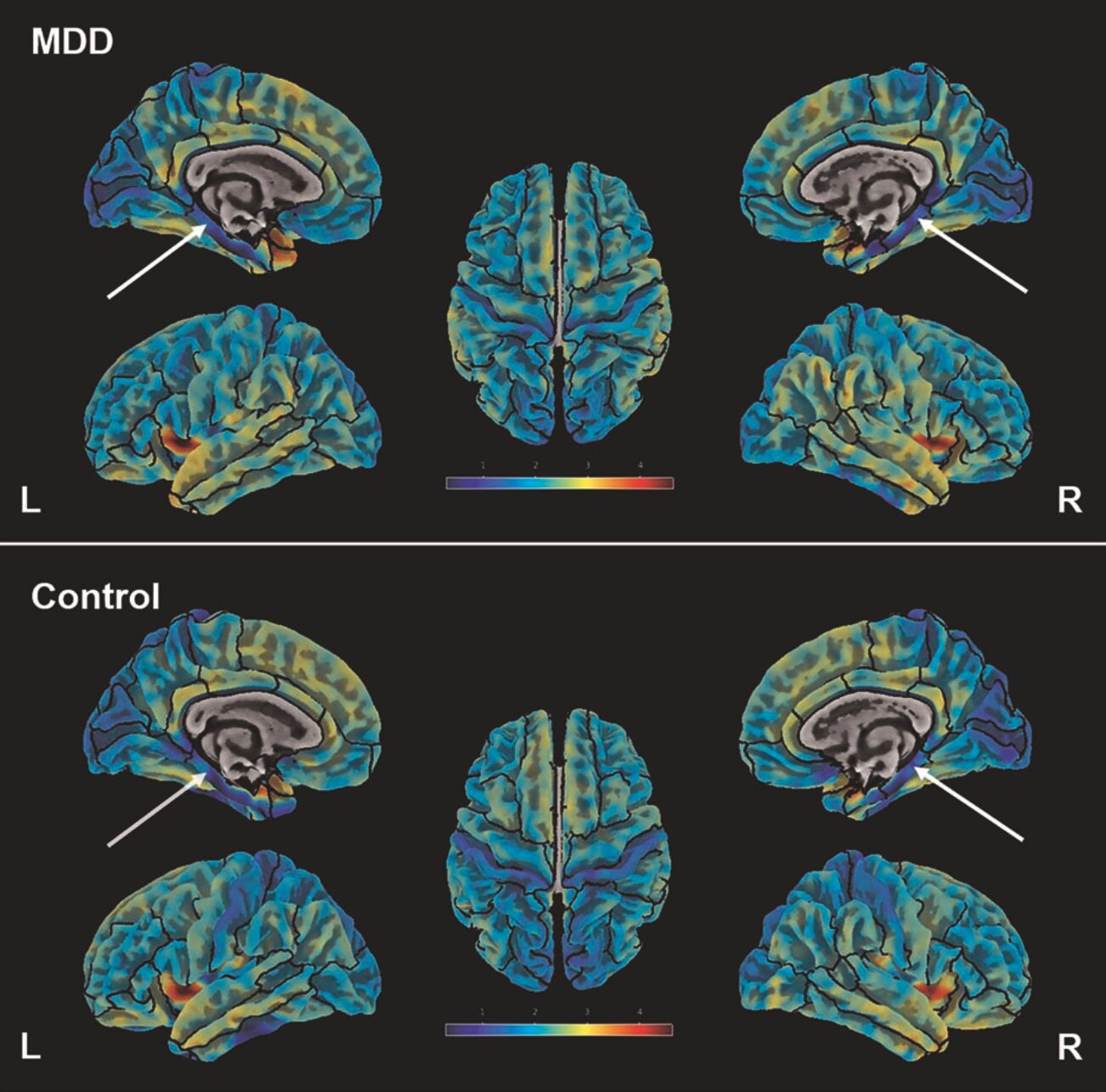 Featured image for Brain scans link parahippocampal thinning to depression and neuroticism