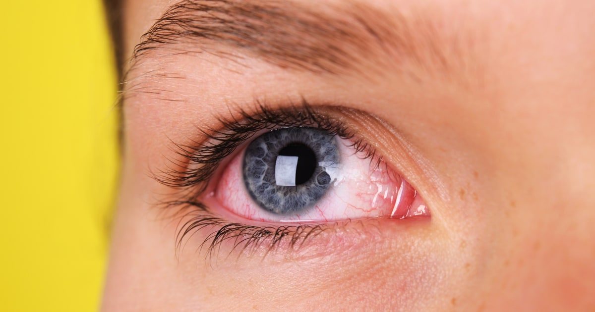 Featured image for "Rising STD Epidemic: Ocular Syphilis Symptoms Causing Eye Problems"