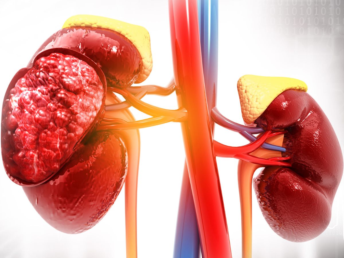 Featured image for "Protect Your Kidneys: Recognizing Symptoms and Taking Action"