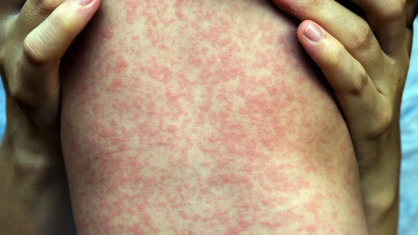 South Carolina Measles Outbreak Brings Encephalitis and Hospitalizations