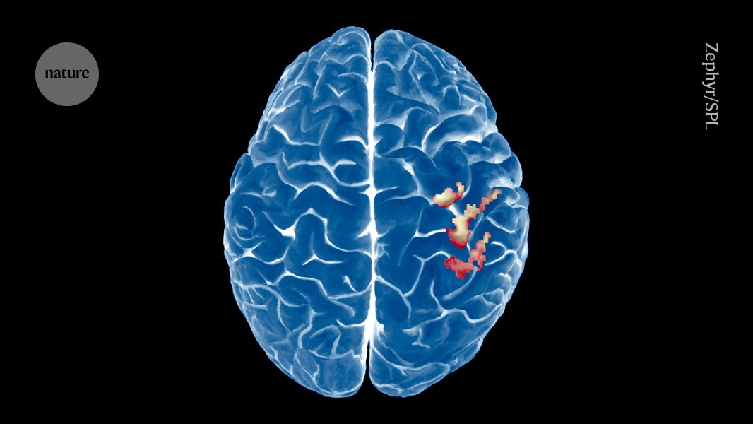 Featured image for Brain's Body Map Remains Stable After Limb Loss, Offering New Insights