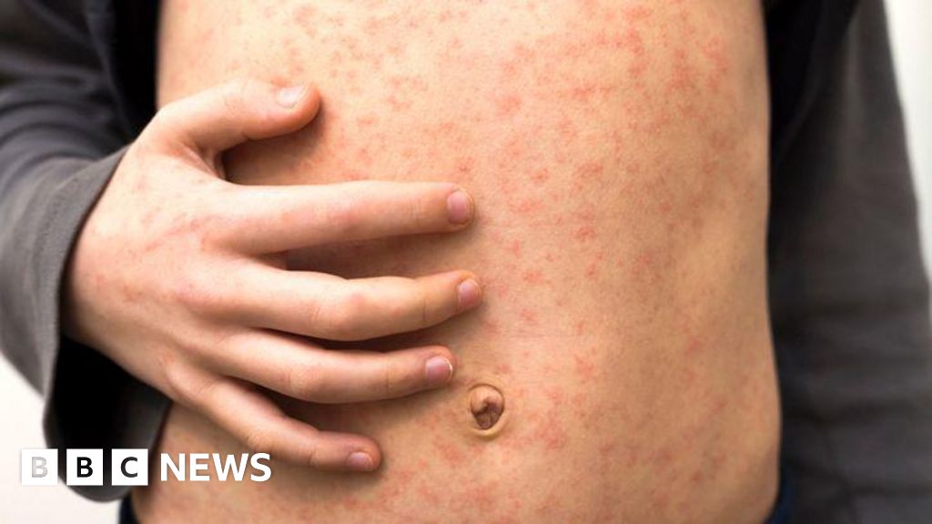 Featured image for Urgent Health Warnings as Measles and Brain Disease Threaten Summer Holidays