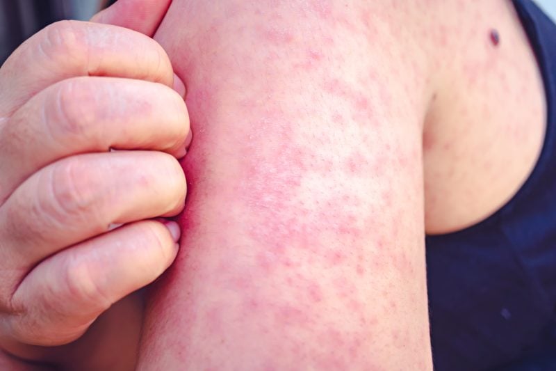 Featured image for Measles Exposure Alert at Sam's Club in Cook and DuPage Counties