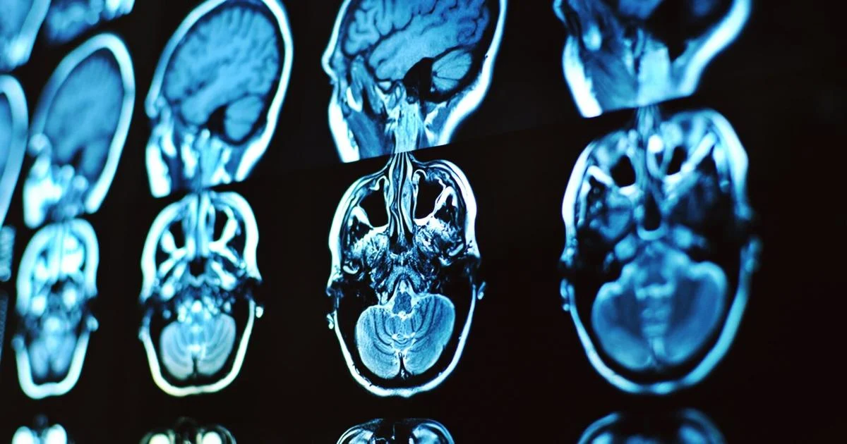 Featured image for Scientists Uncover Biological Cause of Long COVID Brain Fog