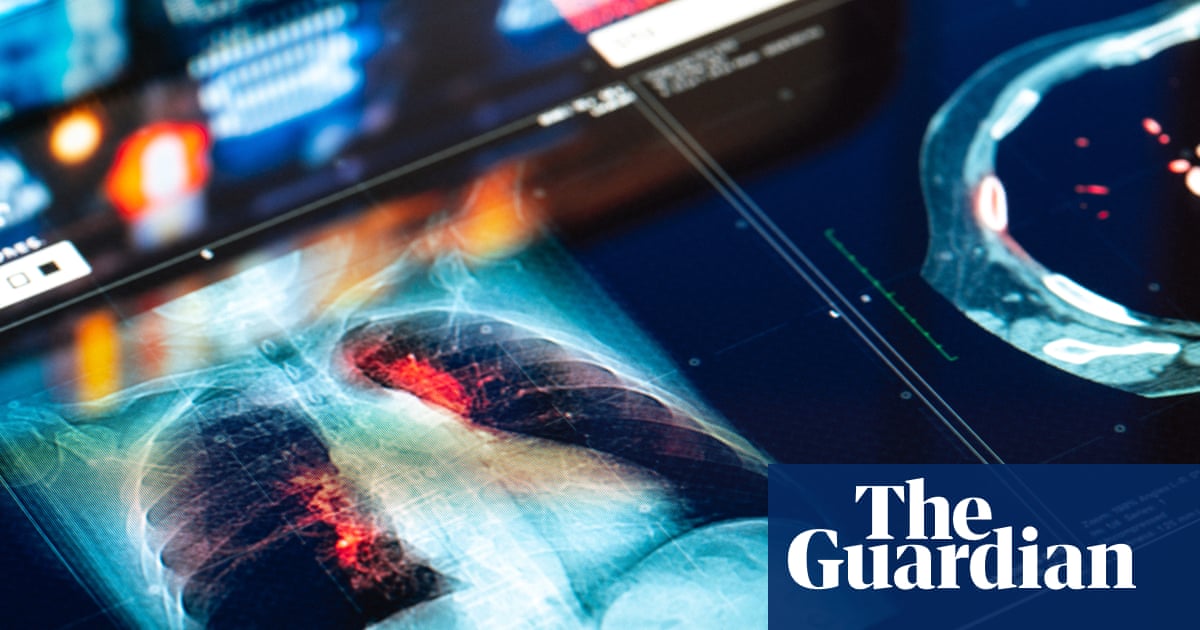 Pfizer's Lung Cancer Drug Shows Remarkable 5-Year Survival Rates