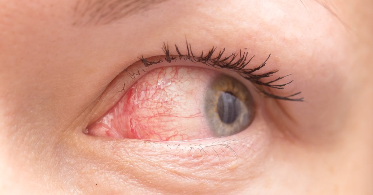 Featured image for COVID-19 Variant Linked to Pink Eye, Warns Doctors.