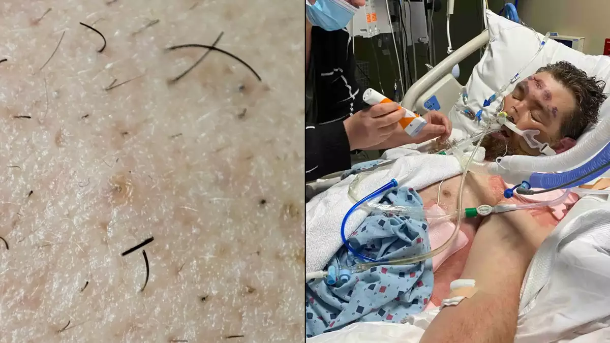 Featured image for "Surviving Deadly Sepsis: Man's Coma Journey from Ingrown Hair"