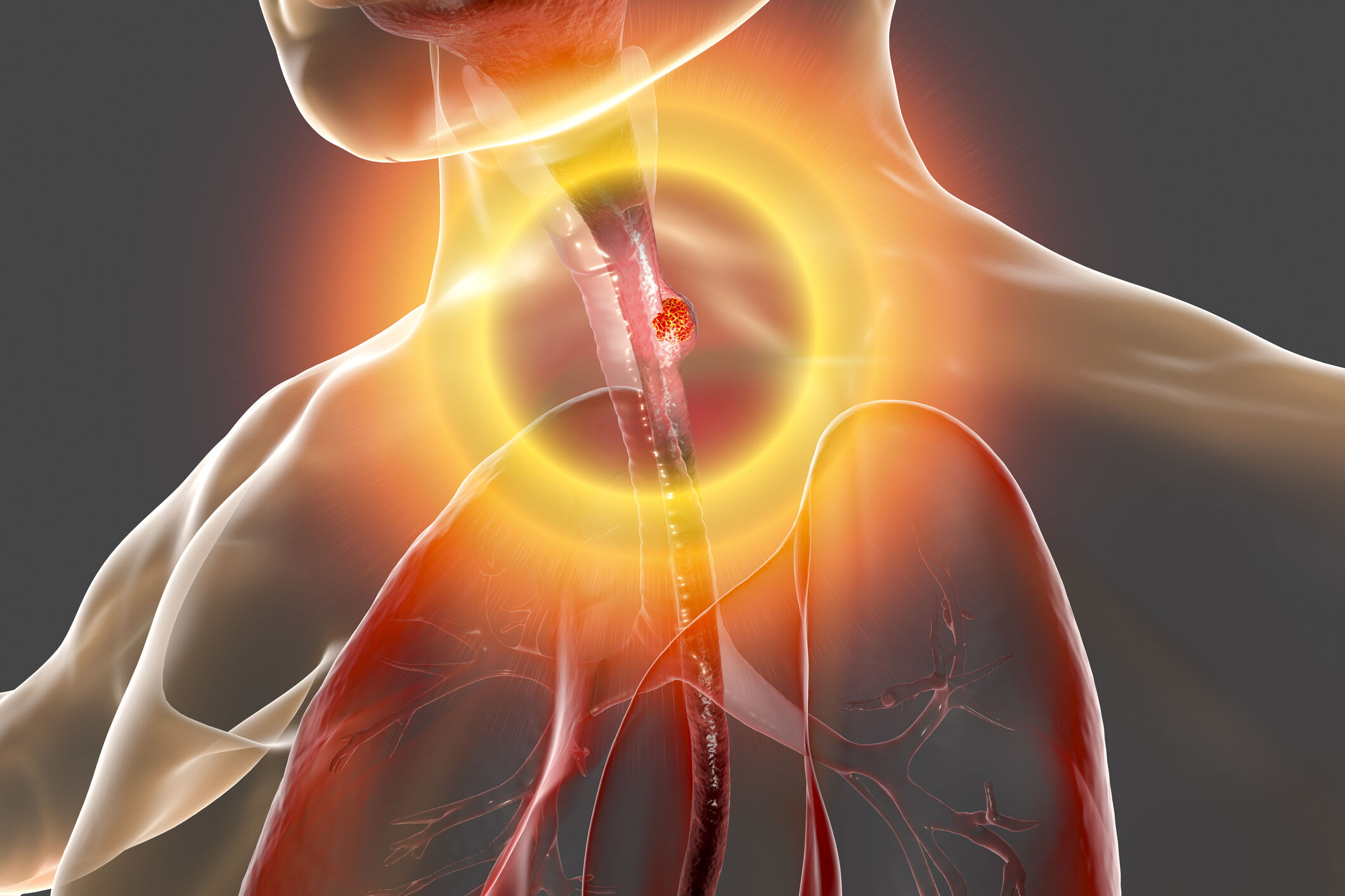 Featured image for "Recognizing the Symptoms of Esophageal Cancer"