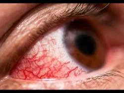 Westmoreland Health Department Warns of Pink Eye Outbreak