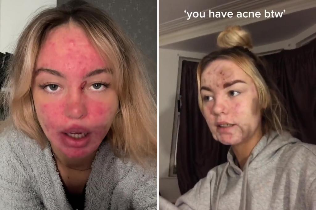 The Devastating Effects of Acne on Self-Esteem and Mental Health.