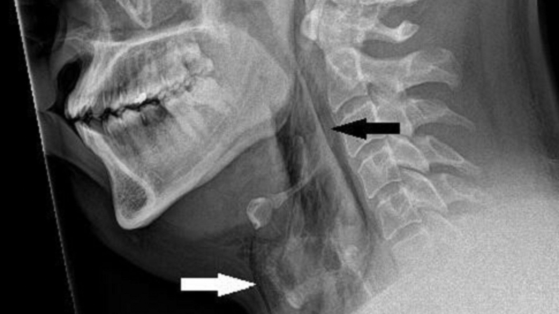 Featured image for The Dangers of Suppressing a Sneeze: Man Rips Windpipe Open