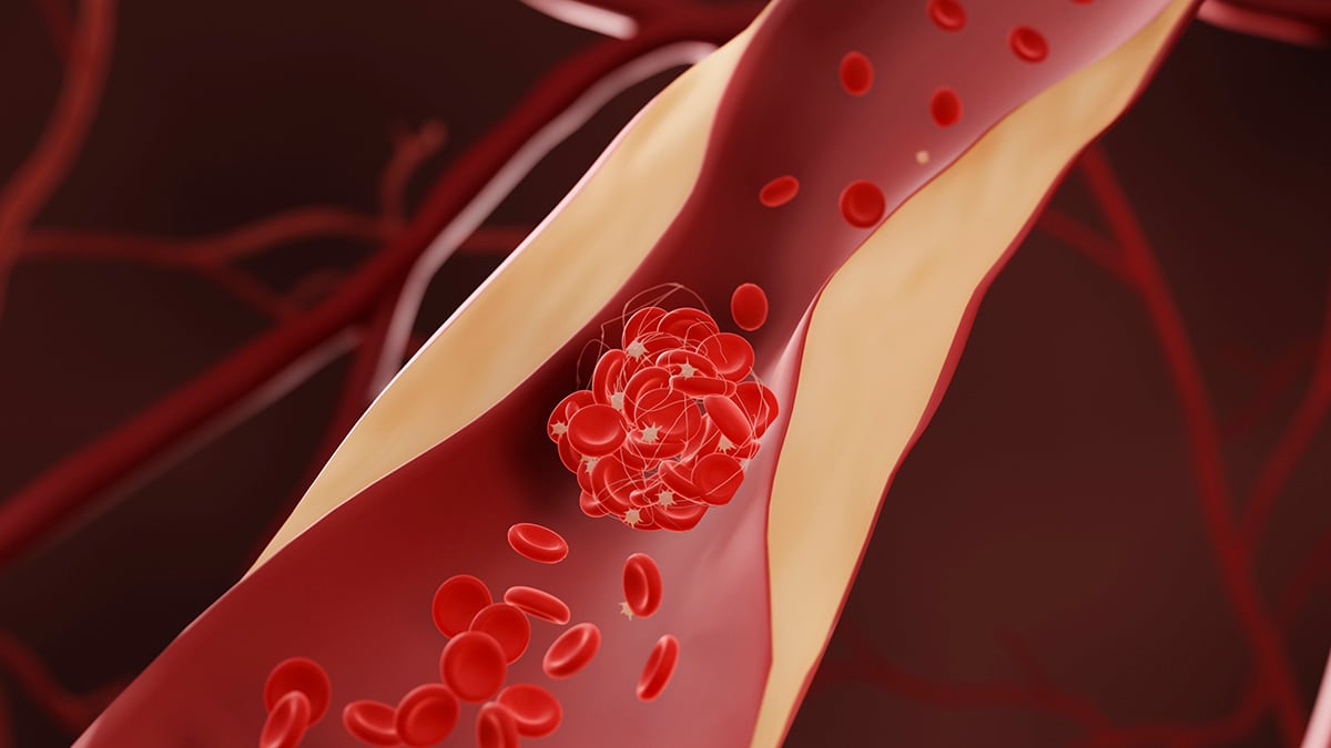 Featured image for Cholesterol-Lowering Drugs May Cut Dementia Risk, Study Finds