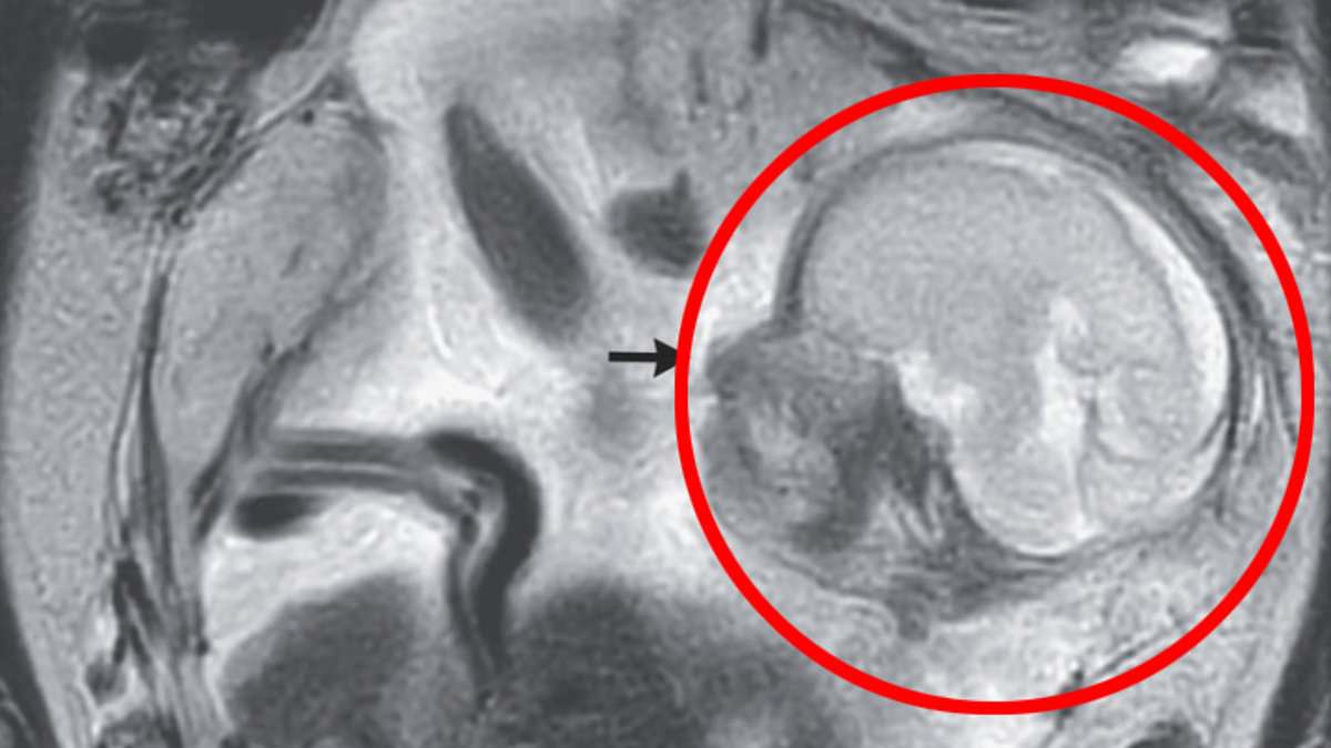 Featured image for "Shocking Diagnosis: Woman Discovers Baby Growing in Bowel"