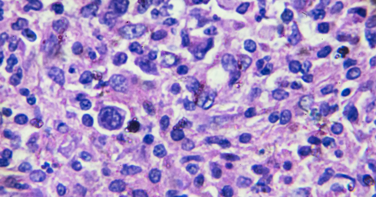 Featured image for FDA Warns of Increased Cancer Risk from CAR-T Therapy