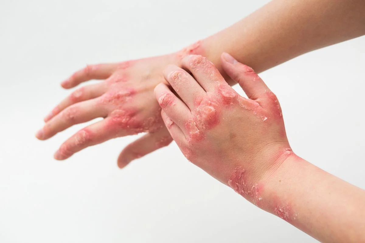 Featured image for Deadly Fungus Spreads Nationwide Amid Rising Drug Resistance