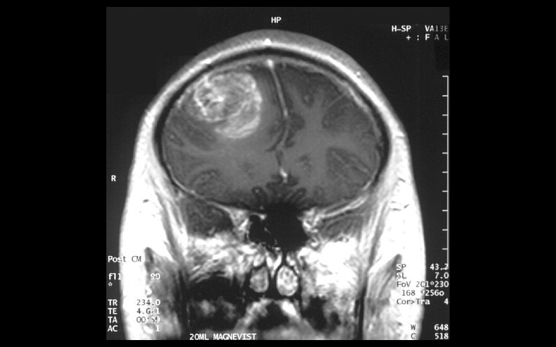 Featured image for "Promising Results: CAR-T Cell Therapy Shrinks Brain Tumors in Early Trials"