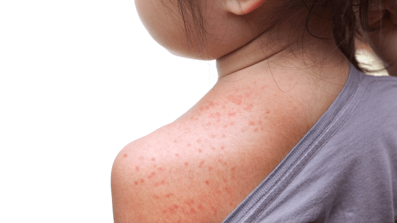 Featured image for "Global Measles Outbreaks Prompt Urgent Vaccination Reminder"