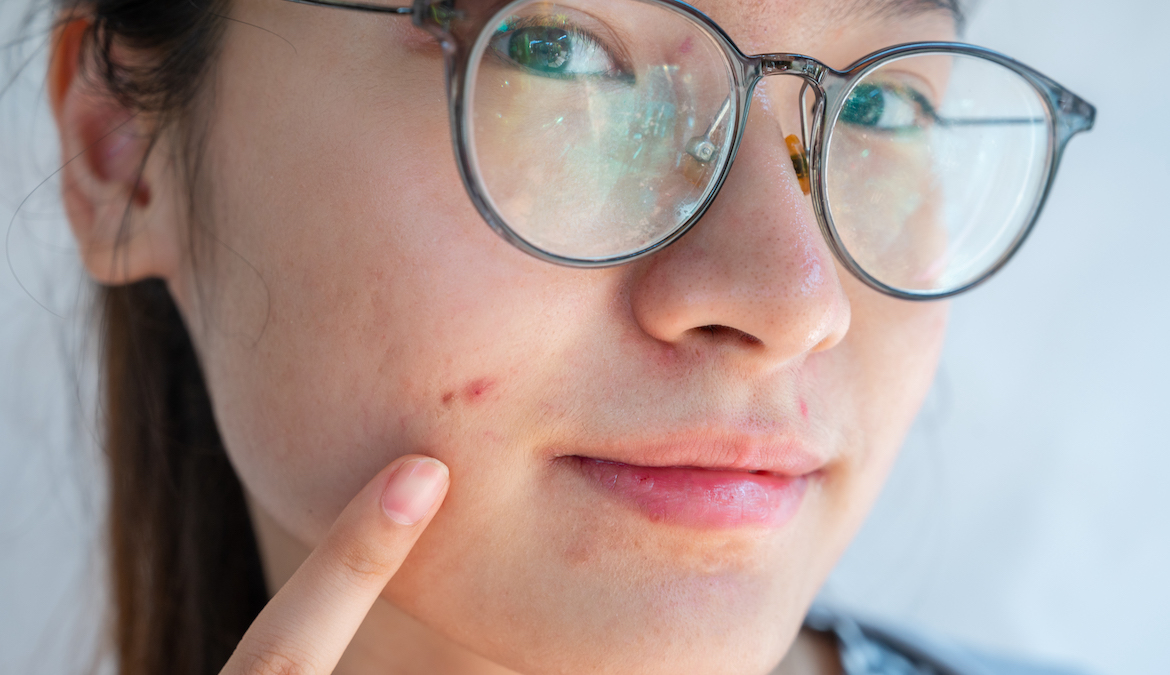 "Revolutionary Acne-Fighting Tips from Top Dermatologists"