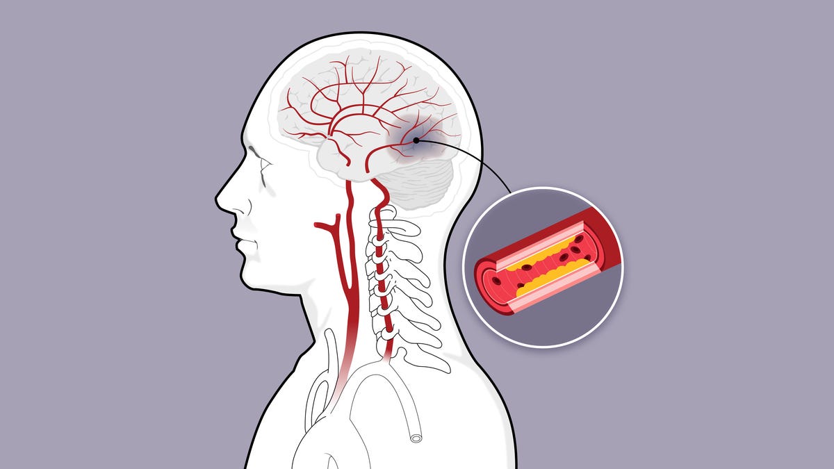 "Spotting Stroke: Easy Ways to Recognize Warning Signs"