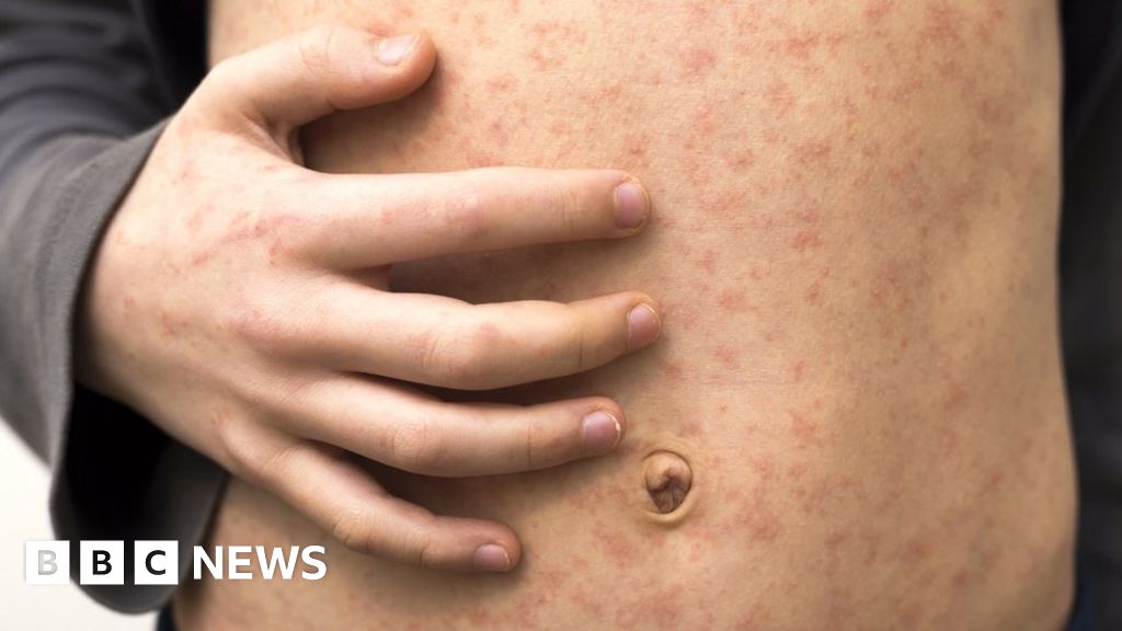 "Understanding and Preventing Measles Outbreaks: A Comprehensive Guide"