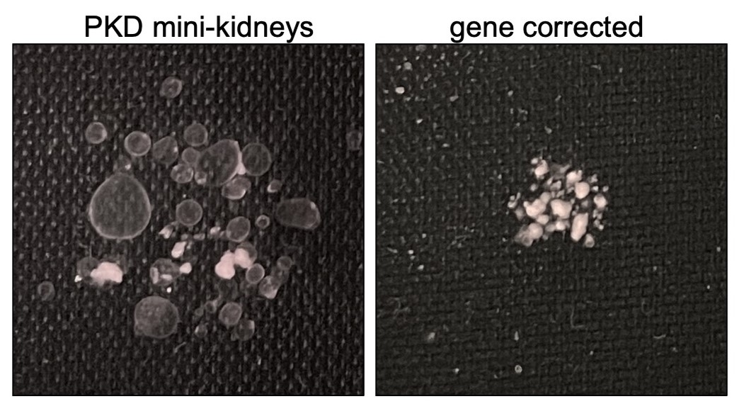 Featured image for "Novel Treatment Approaches Unveiled for Polycystic Kidney Disease"