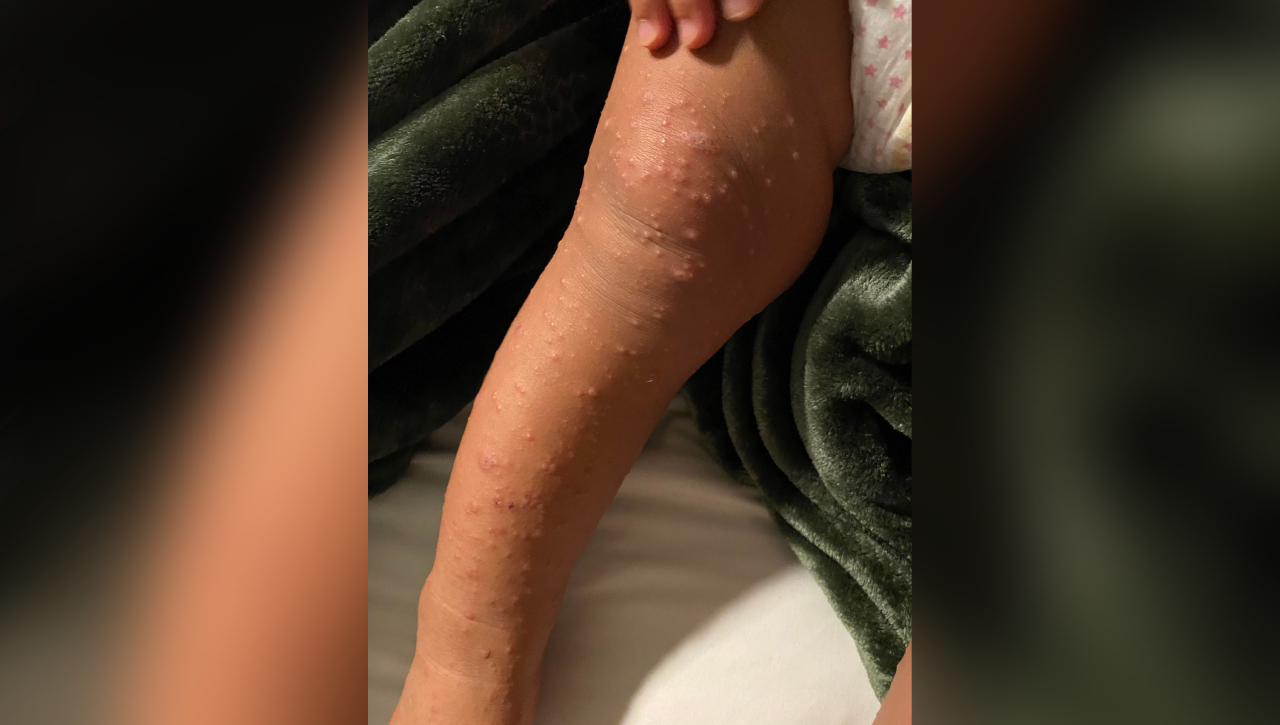 Featured image for "Mom Alerts Community After Son Contracts Hand Foot Mouth Disease at Splash Pad"