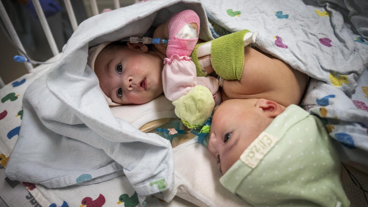 Texas conjoined twins successfully separated, finally go home