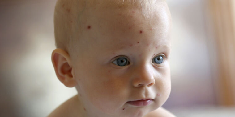 Featured image for Study Reveals Over 50% of Chickenpox Diagnoses are Inaccurate
