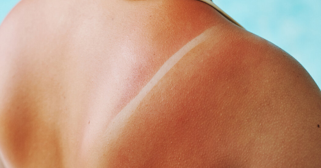 Featured image for Sunburn SOS: Effective Treatment Tips.