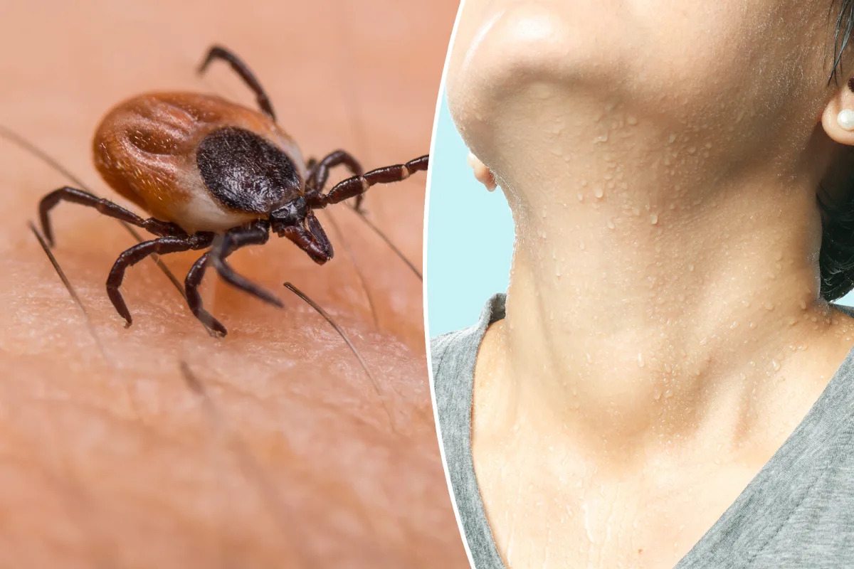 "Human Sweat: A Potential Key to Preventing Lyme Disease, Say Scientists"